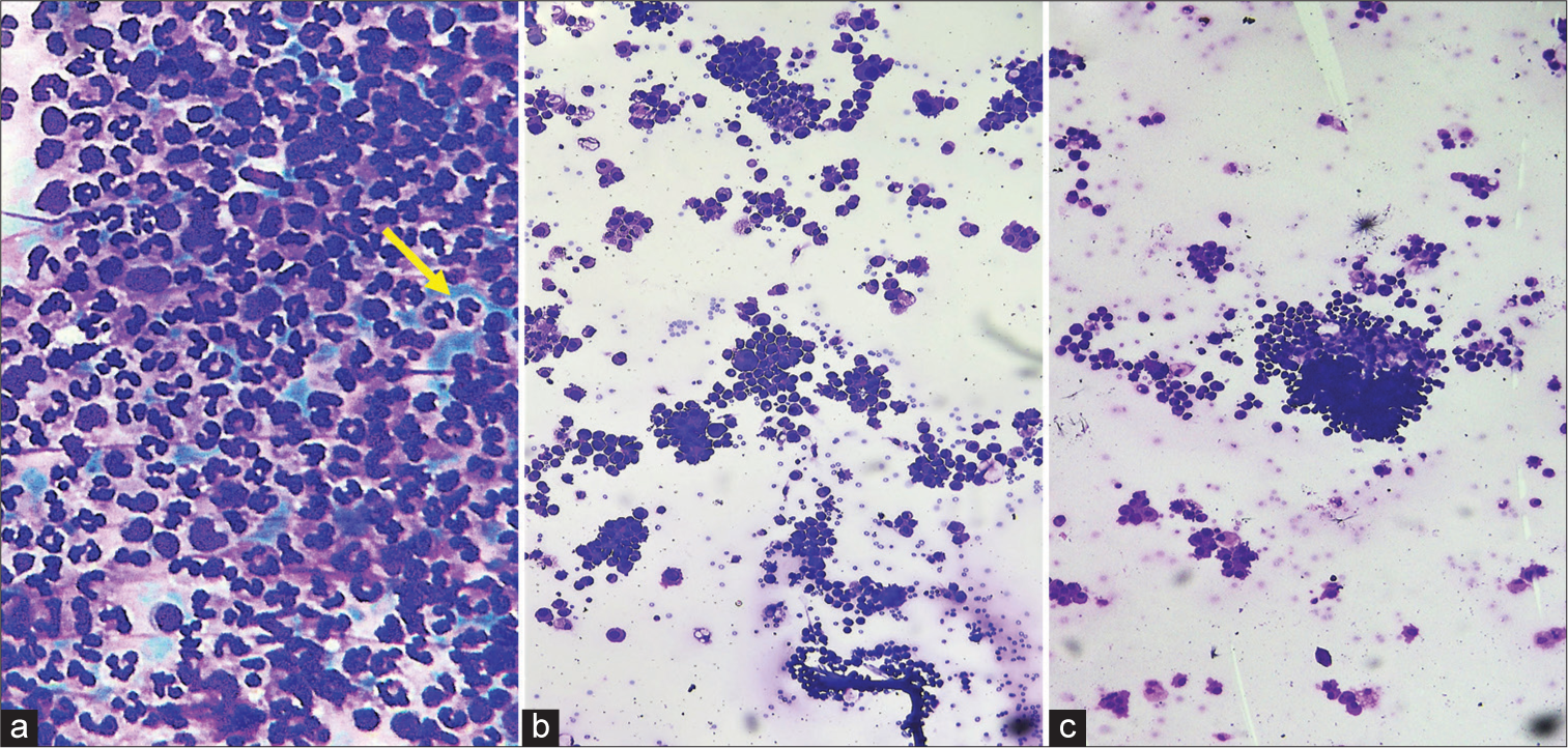 Utility of anticoagulation, pre-smearing and post-smearing hemolytic techniques on morphological assessment and reproducibility in fluid cytology